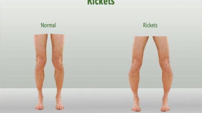 Diagnosis of rickets
