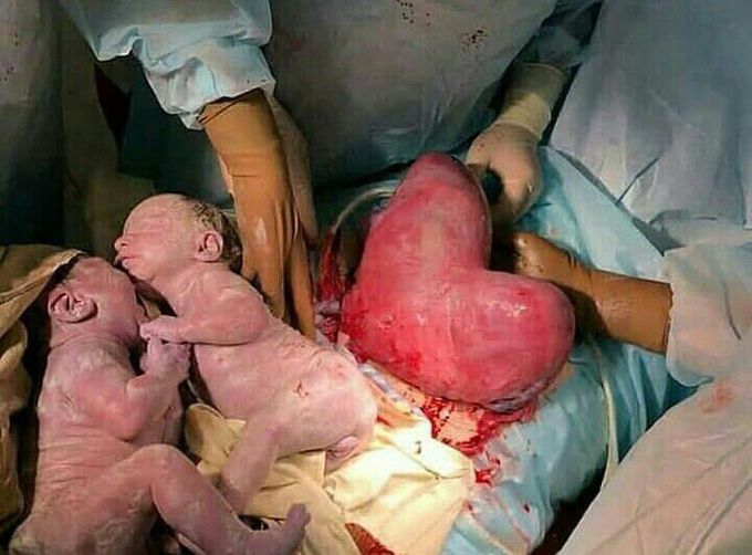 Heart shaped womb