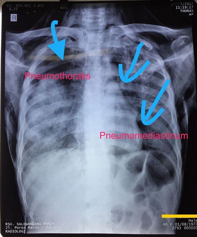 Pneumothorax and pneumomediastinum
