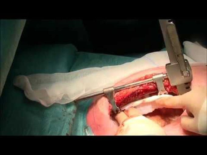 MMCTS - Skeletonized internal mammary artery harvest with diathermy, cold dissection