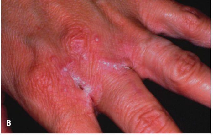 Chronic mucocutaneous candidiasis