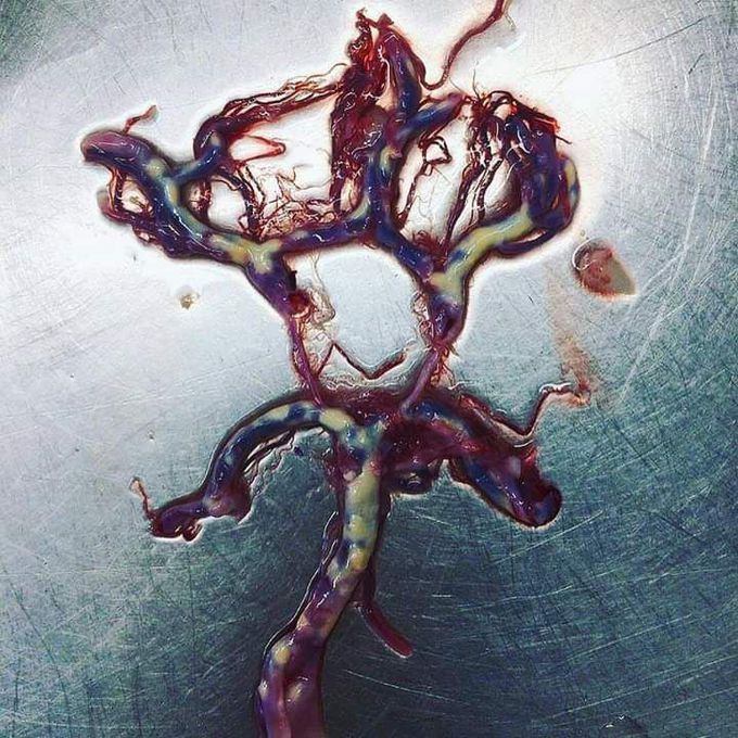 Atherosclerosis   circle of willis leads to ischemic stroke