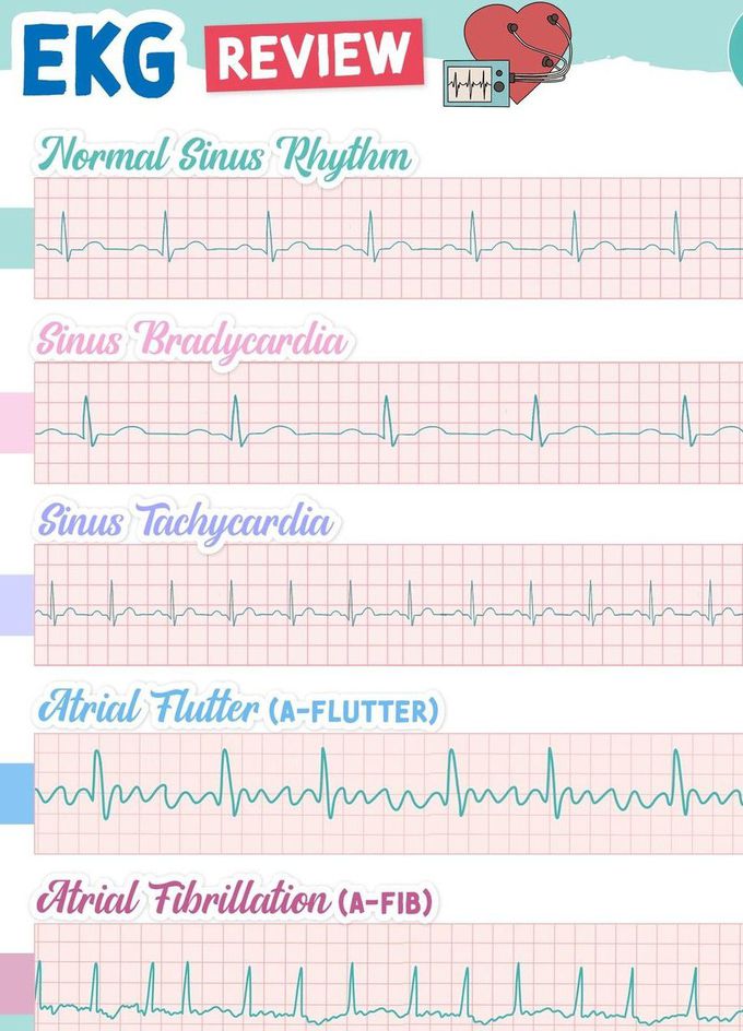 EKG  review I