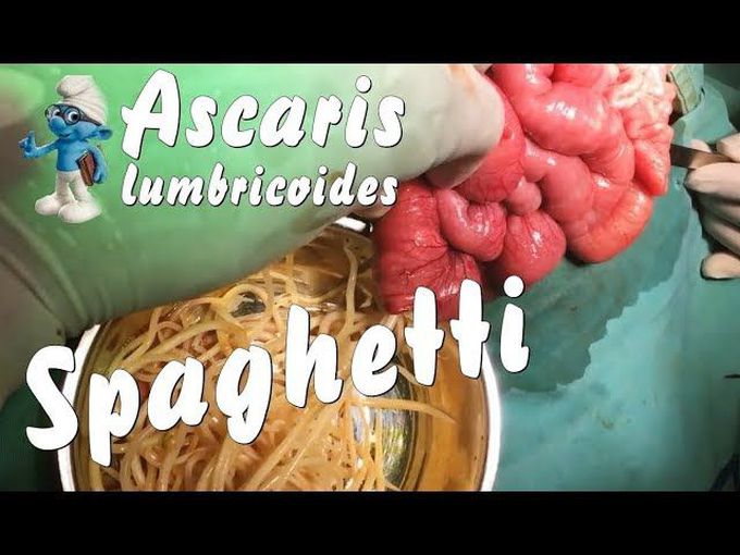 Ascaris lumbricoides | Such as Spaghetti !!