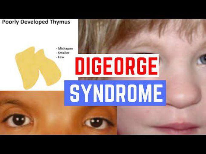 DiGeorge Syndrome -Neurocristopathies