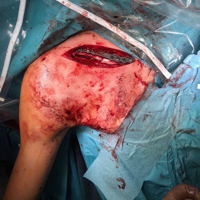 Fracture of clavicle repaired with Titanium plate