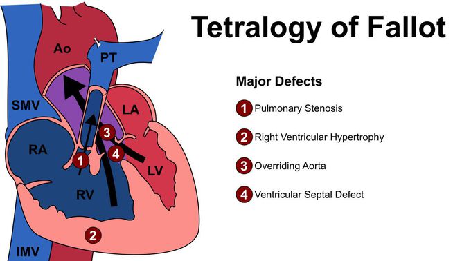 Major Defects in Tetralogy of Fallot