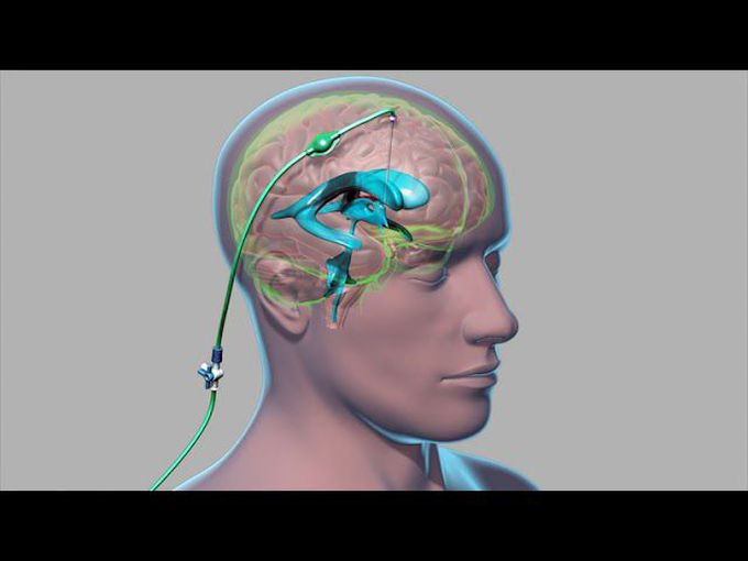 External Ventricular Drain (EVD)