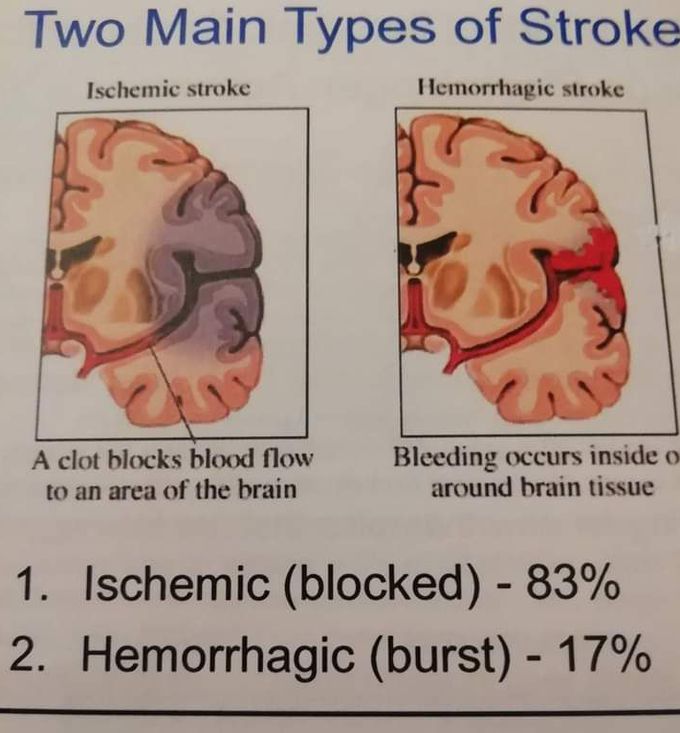 Brain stroke