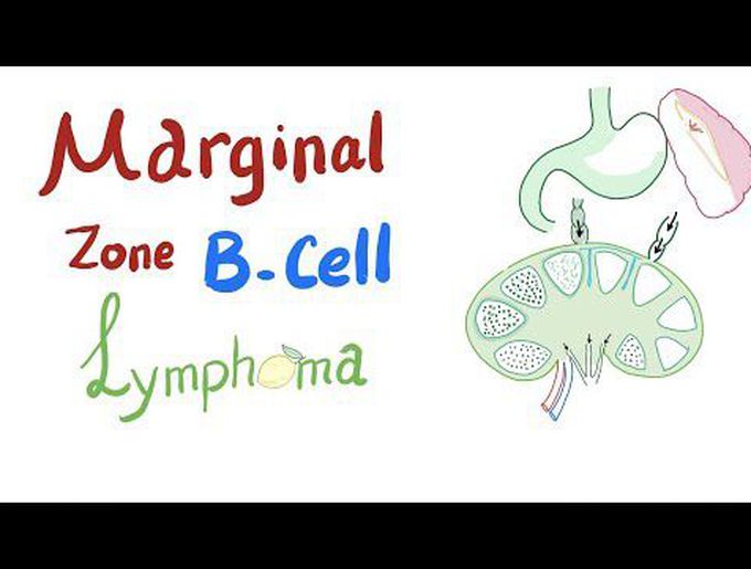 Pathology of Marginal Zone B-Cell lymphoma (MALToma)