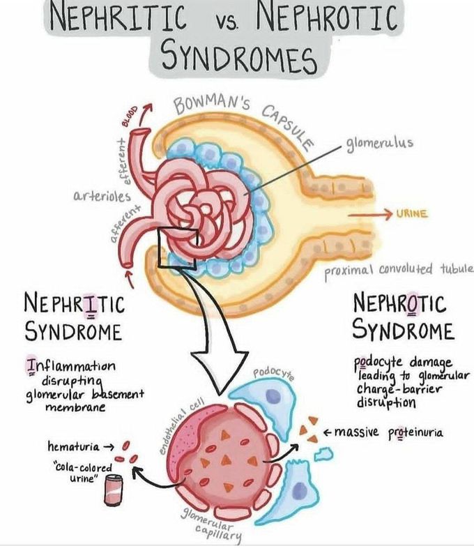Nephritic Vs Nephrotic Syndrome