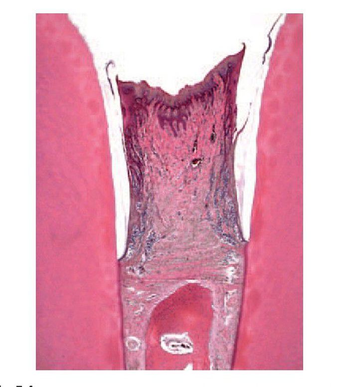 Chronic gingivitis.