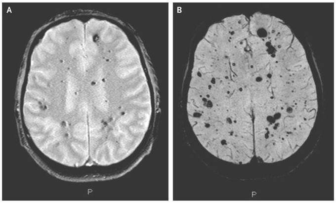 Cerebral Cavernous Malformations