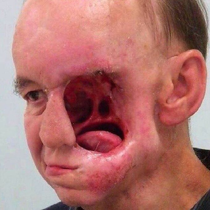 Extensively Erosive Cancer of face