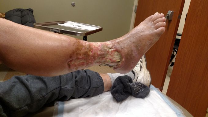 Gangrene