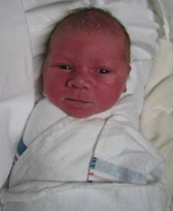 Токсическая Эритема Новорожденных Фото – Telegraph