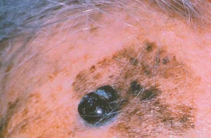 Lentigo Maligna Melanoma