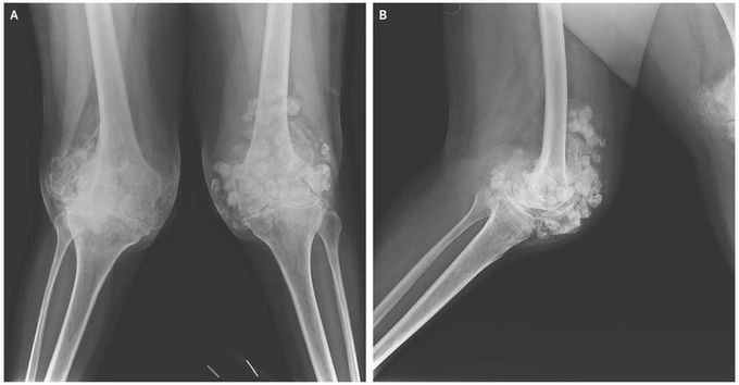 Synovial Chondromatosis