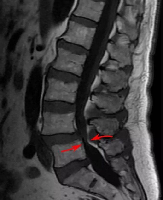 Lumbar Spinal Stenosis