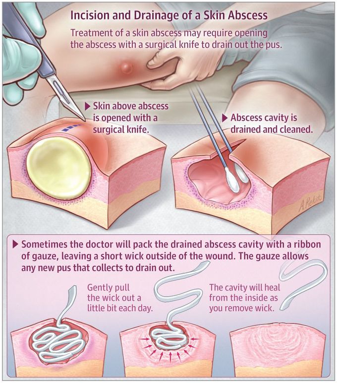 Incision and Drainage of skin abscess