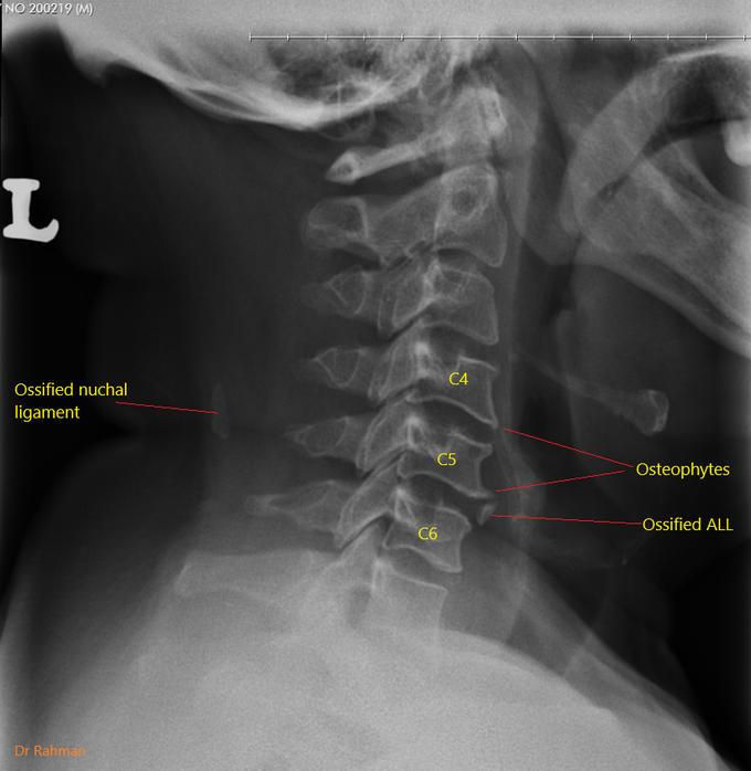 Cervical spondylitis