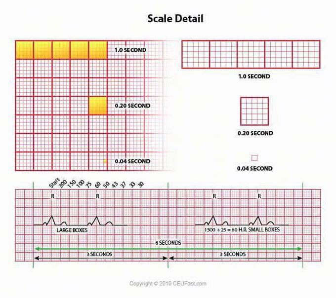 A method in 6 lead ECG