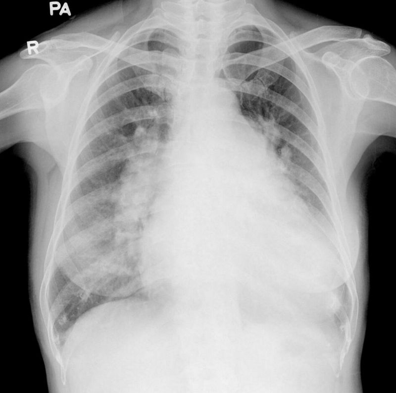 Eisenmenger syndrome - MEDizzy