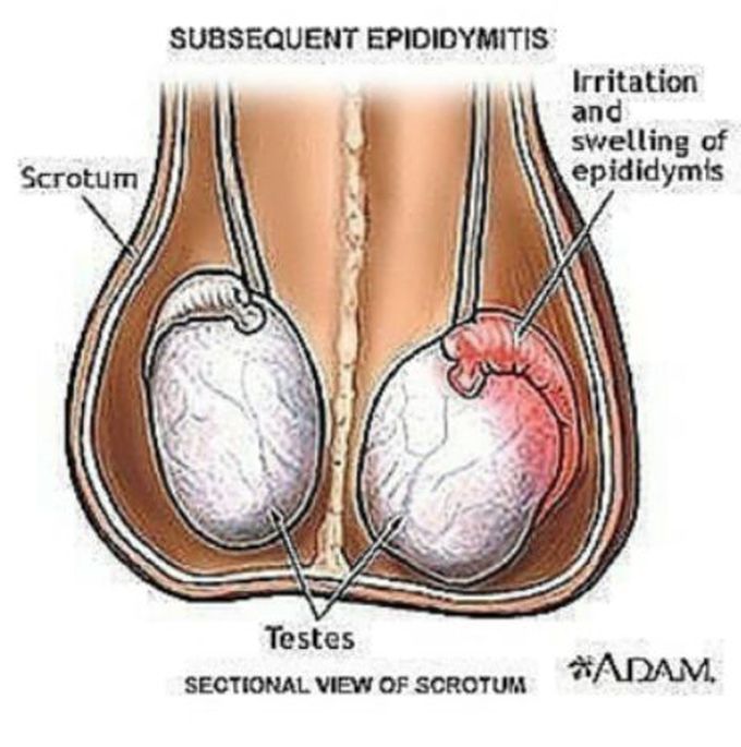 Subsequent epididymitis