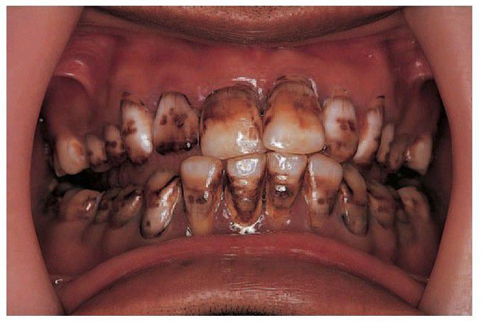 Fluorosis