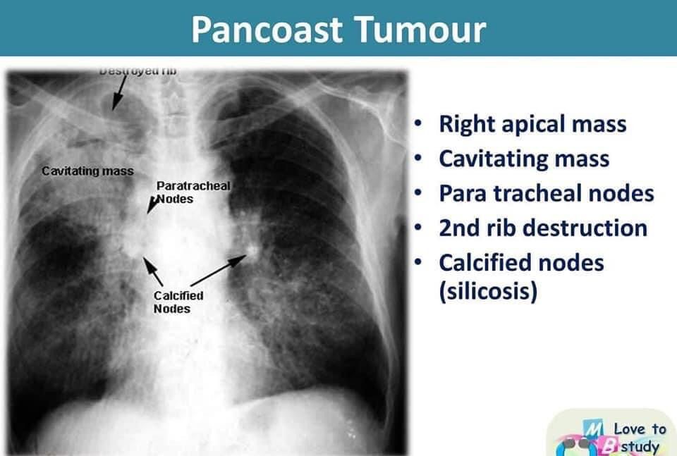 Pancoast Tumor Cxr Medizzy