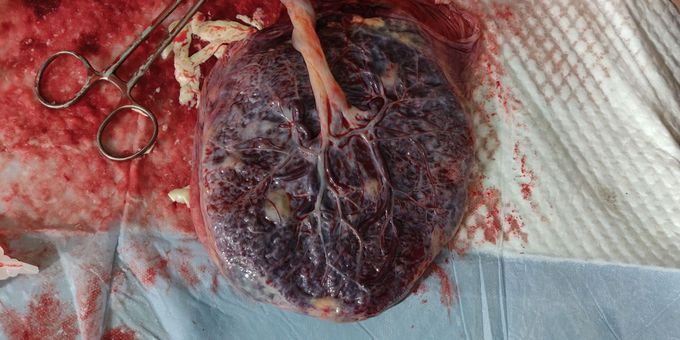 Ageing/Calcified Placenta
