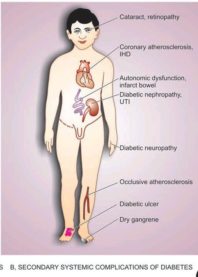 Diabetes mellitus