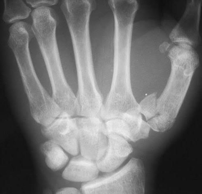 Bennett fracture