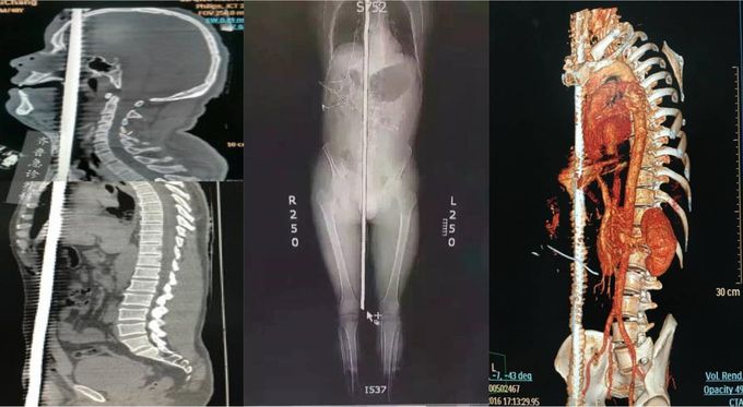 Miraculous recovery of rebar penetrating trauma in construction site worker