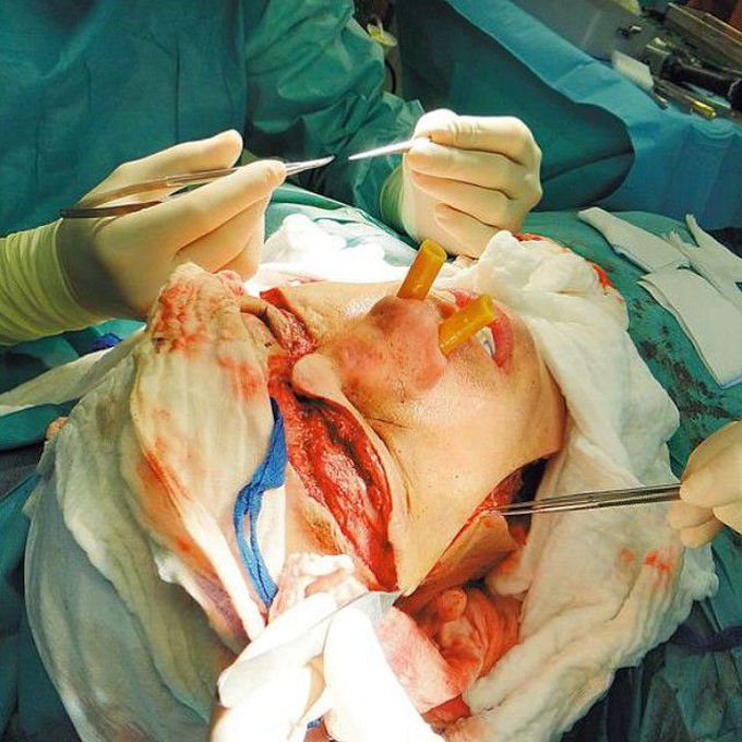 Face transplant surgery