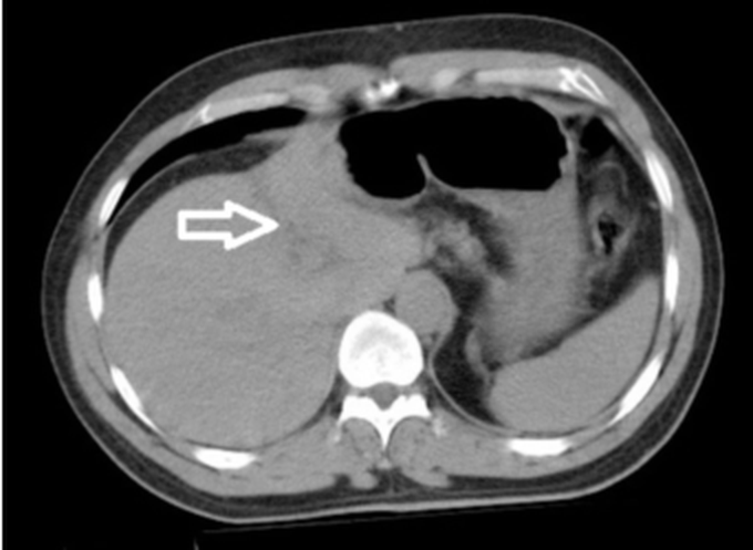 Traumatic injury, CECT