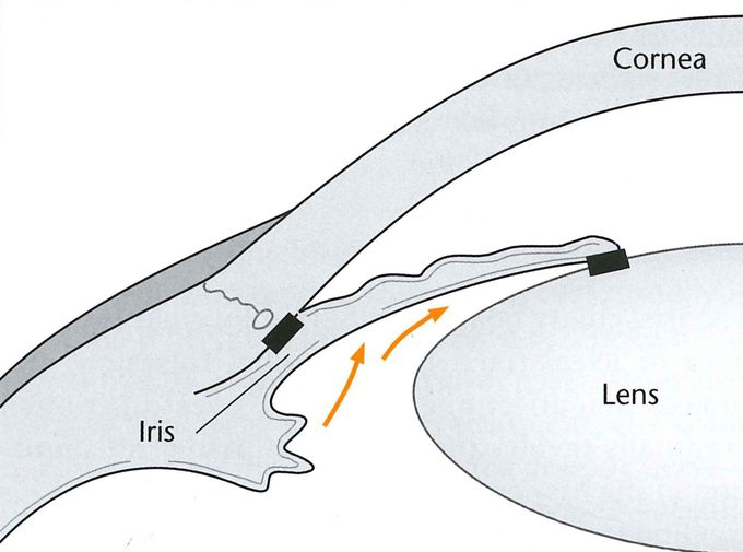 Primary angle closure gluacoma