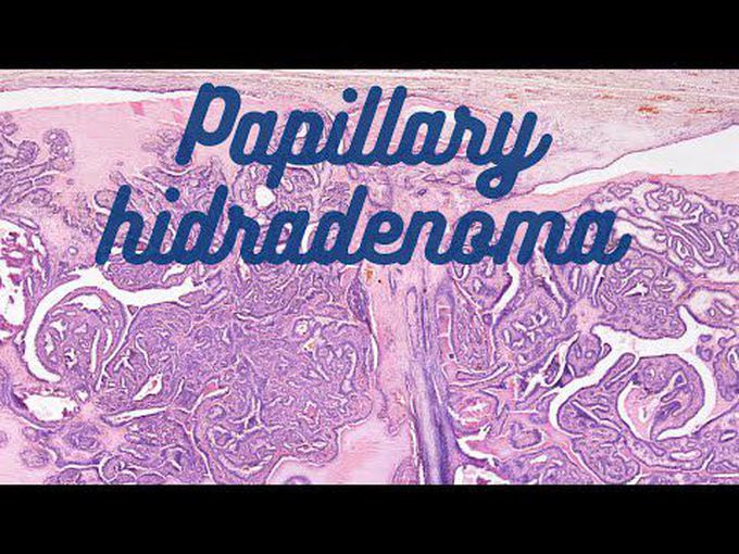 Papillary Hidradenoma