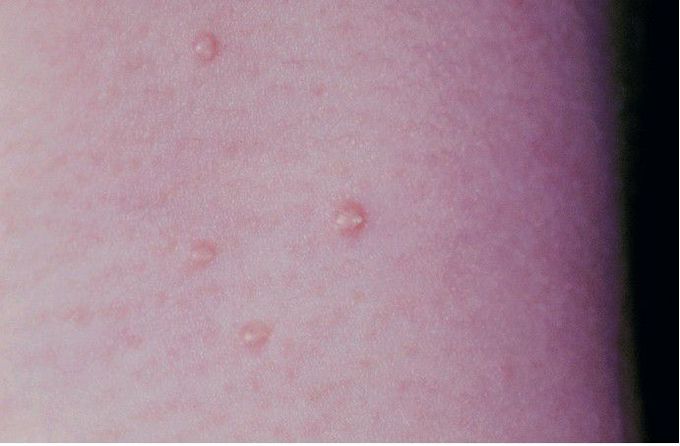 Molluscum Contagiosum.