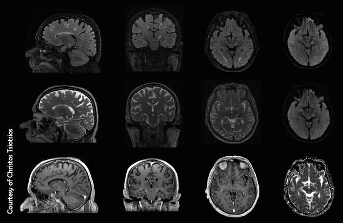 MR Imaging of brain metastasis