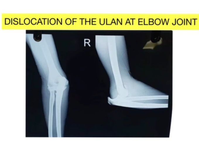 Dislocated Ulna