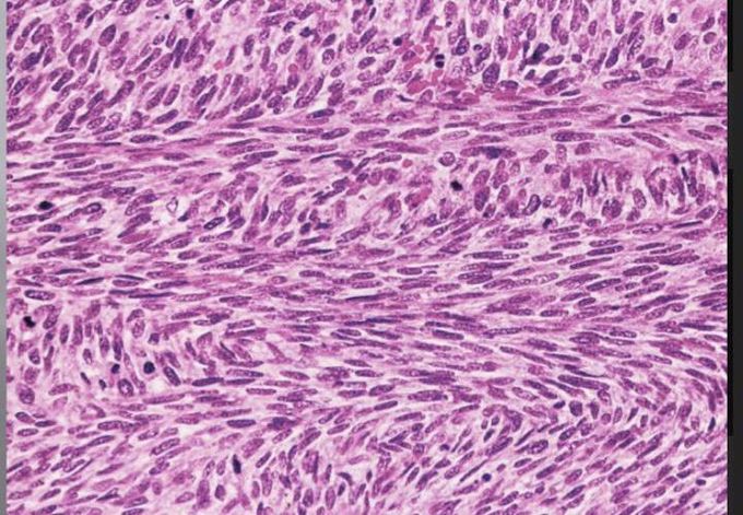 Fibrosarcoma