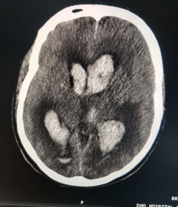 Massive Hemorrhagic CVA