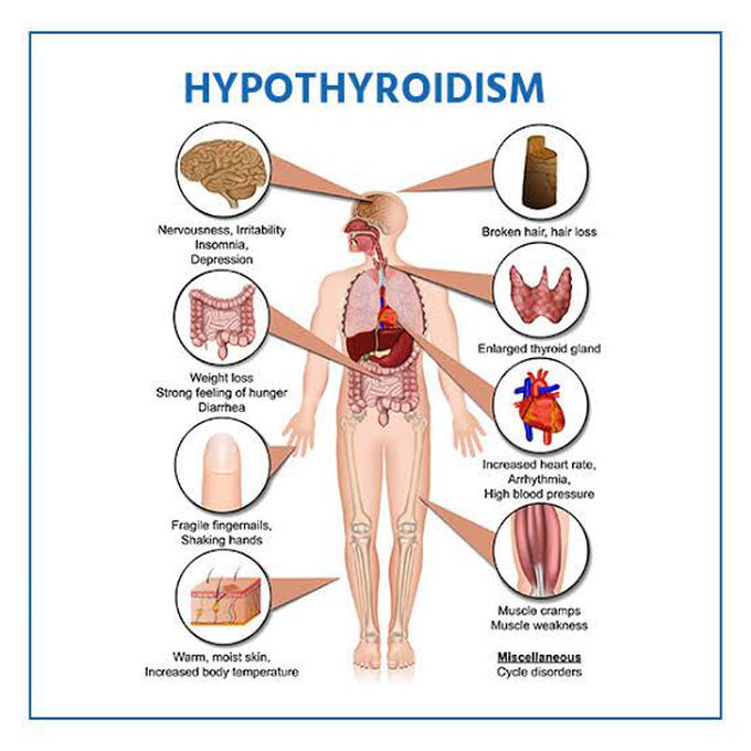 Symptoms of hypothyroidism