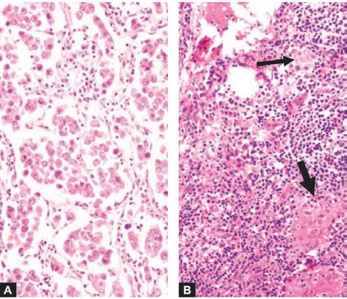 Inflammatory reaction in the stroma of the tumour