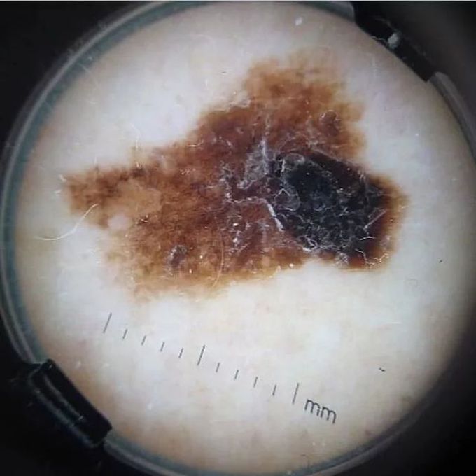 Superficial Spreading Melanoma