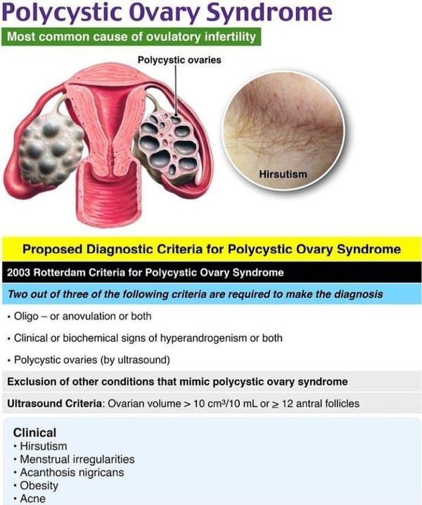 Polycystic Ovarian Syndrome Pcos