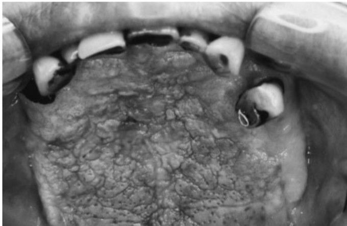 Leukoplakia