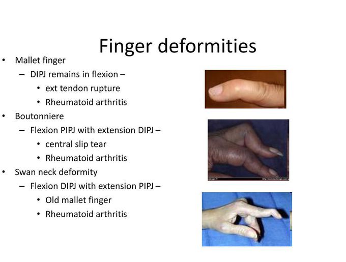 Finger deformity