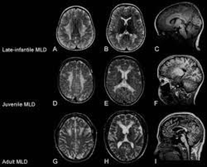 Metachromatic leukodystrophy